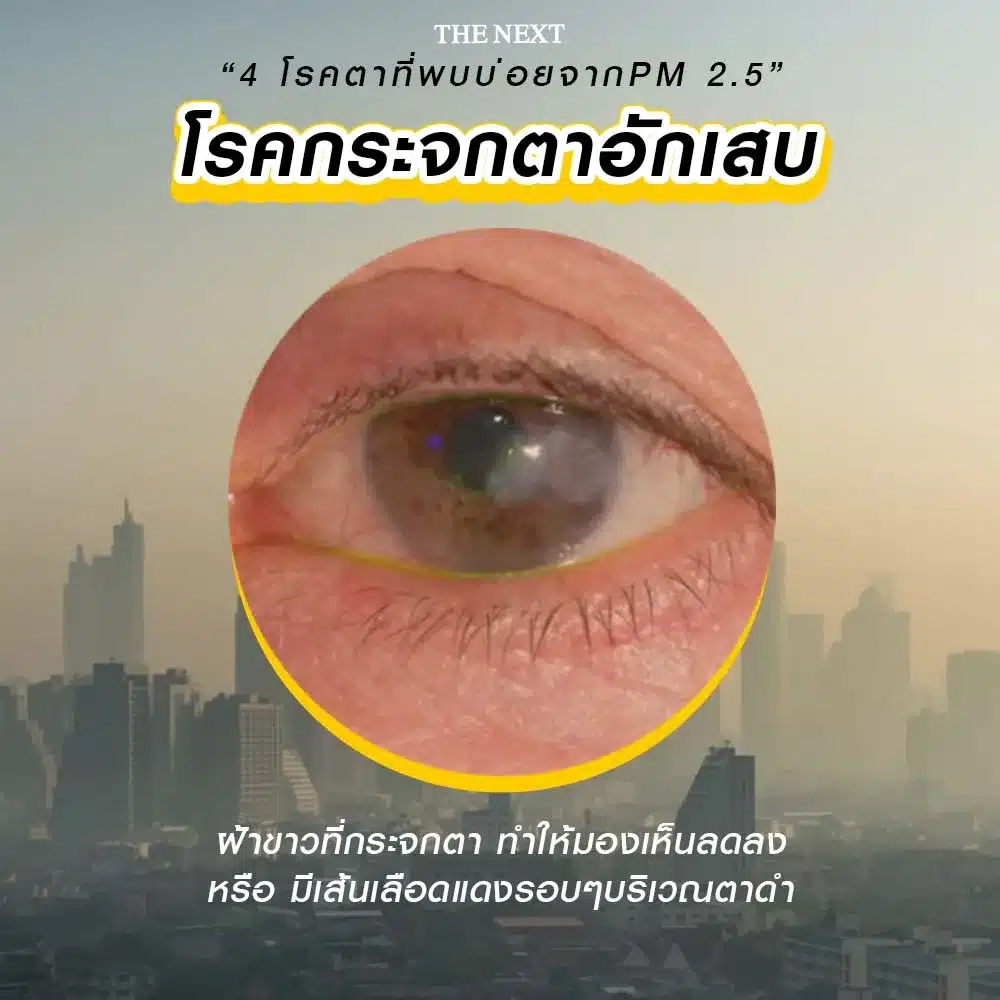 โรคกระจกตาอักเสบ