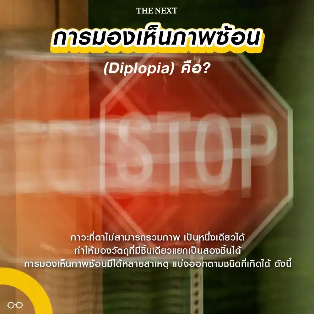 การมองเห็นภาพซ้อน Diplopia คือ?